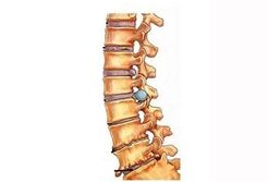 Development phase of cervical osteochondosis