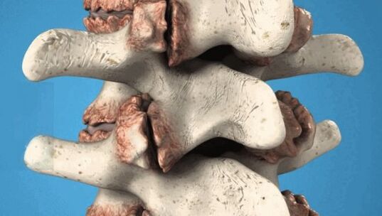 Osteophytes of the vertebrae - pathological classes that damage the nerves and blood vessels