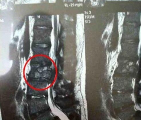 The spine tumor in the photo