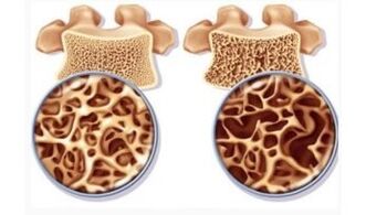 Danger of cervical aspiration for women