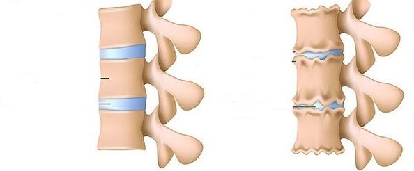 Healthy and osteochondous vertebral column